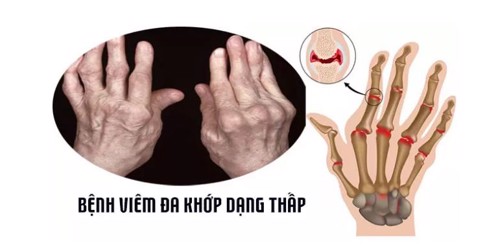 Nguy cơ khiến viêm khớp dạng thấp dễ tái phát